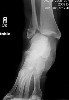 Margie's Broken Ankle Margie's Broken Ankle