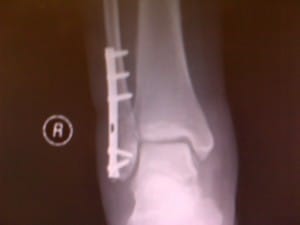Current ankle shot. Still a visible crack by where there's no screw